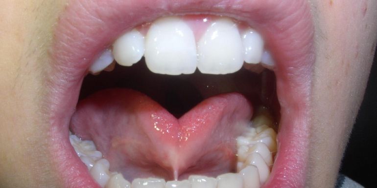 tongue tie causes