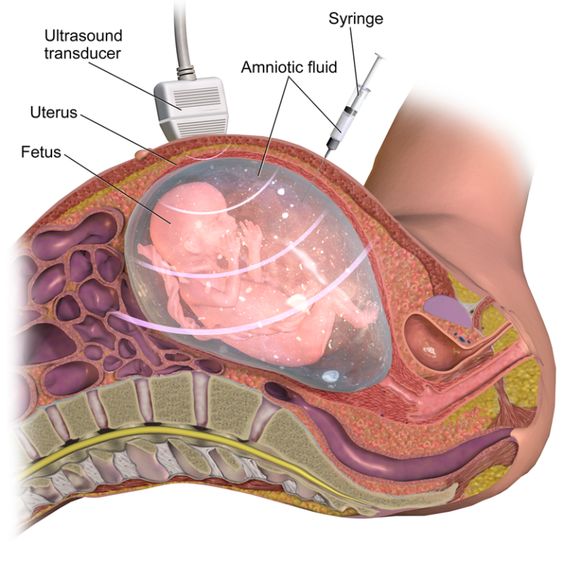 What is Amniocentesis