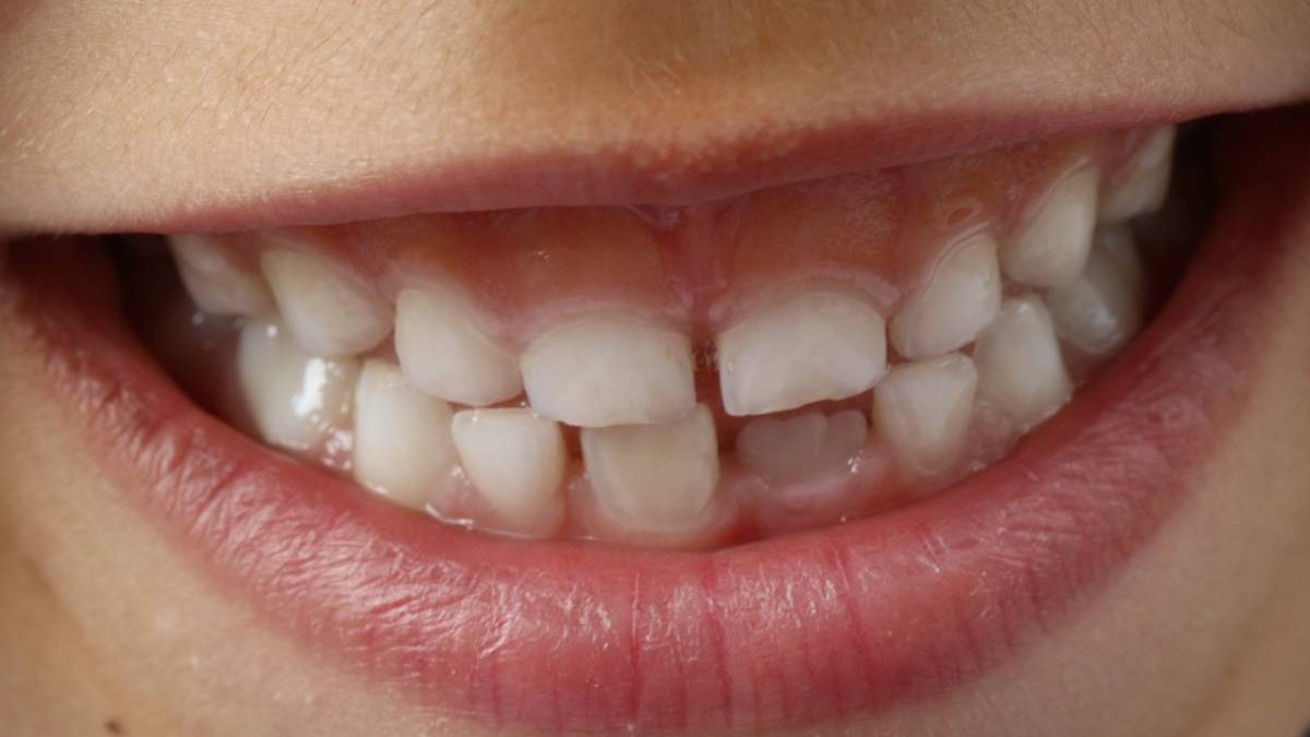 How To Stop Tooth Decay From Spreading?