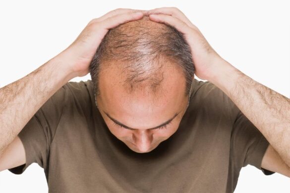 Fighting Male Pattern Baldness