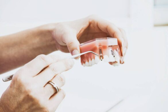 How Dental Implant Healing Goes