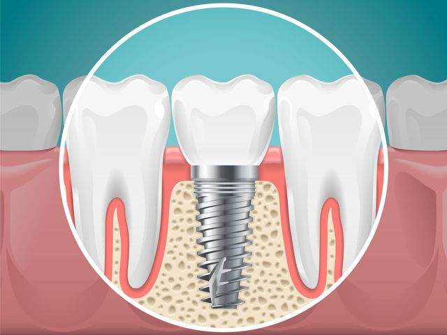dental implants slipping or shifting