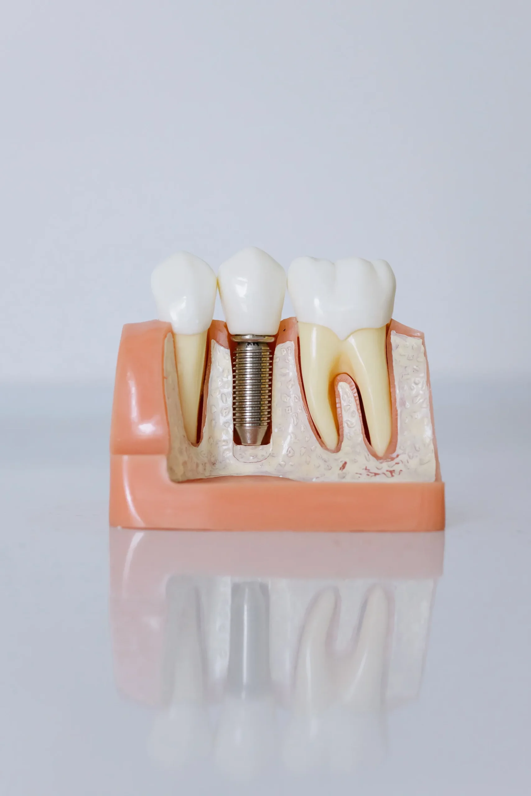 avoid dental implant failure
