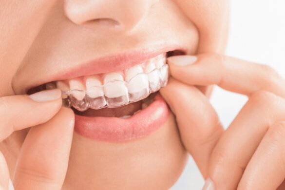 how long does it take to see results from aligners