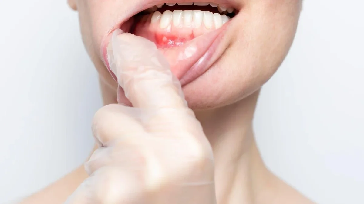Emergency Dentist Talks About the Difference Between Canker Sores and Oral Cancer