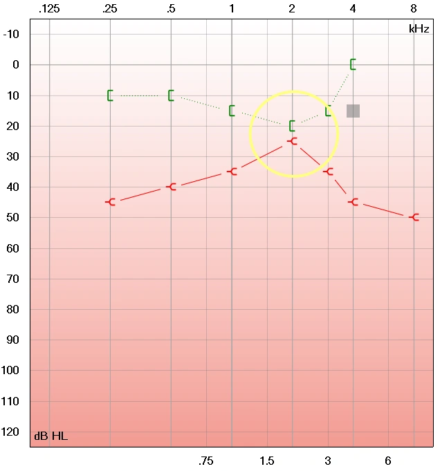Otosclerosis audiogram